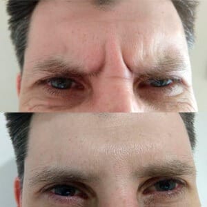 LP - BOTOX 1