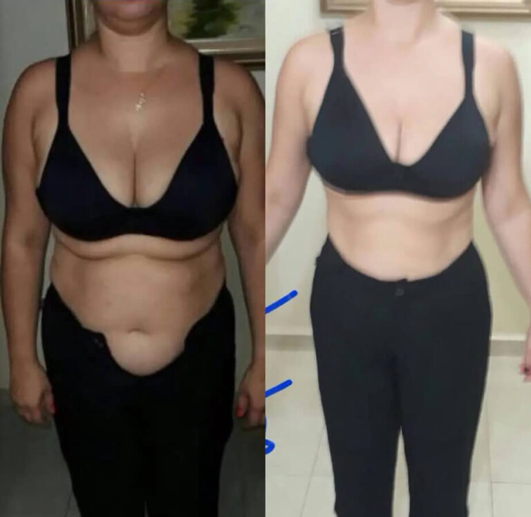 magrass_site_tirzepatida_img_antes_depois_022